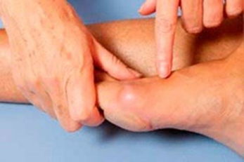 Inchaço e inflamação nas pernas antes de usar o Hondrogel