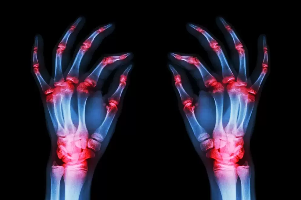 artrose das articulações dos dedos