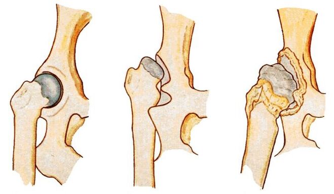 A displasia da anca é uma causa de coxartrose secundária