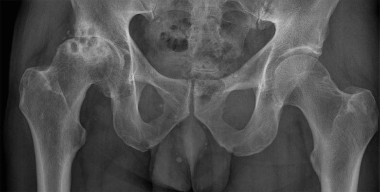 Artrose estágio 3 da articulação do quadril na radiografia