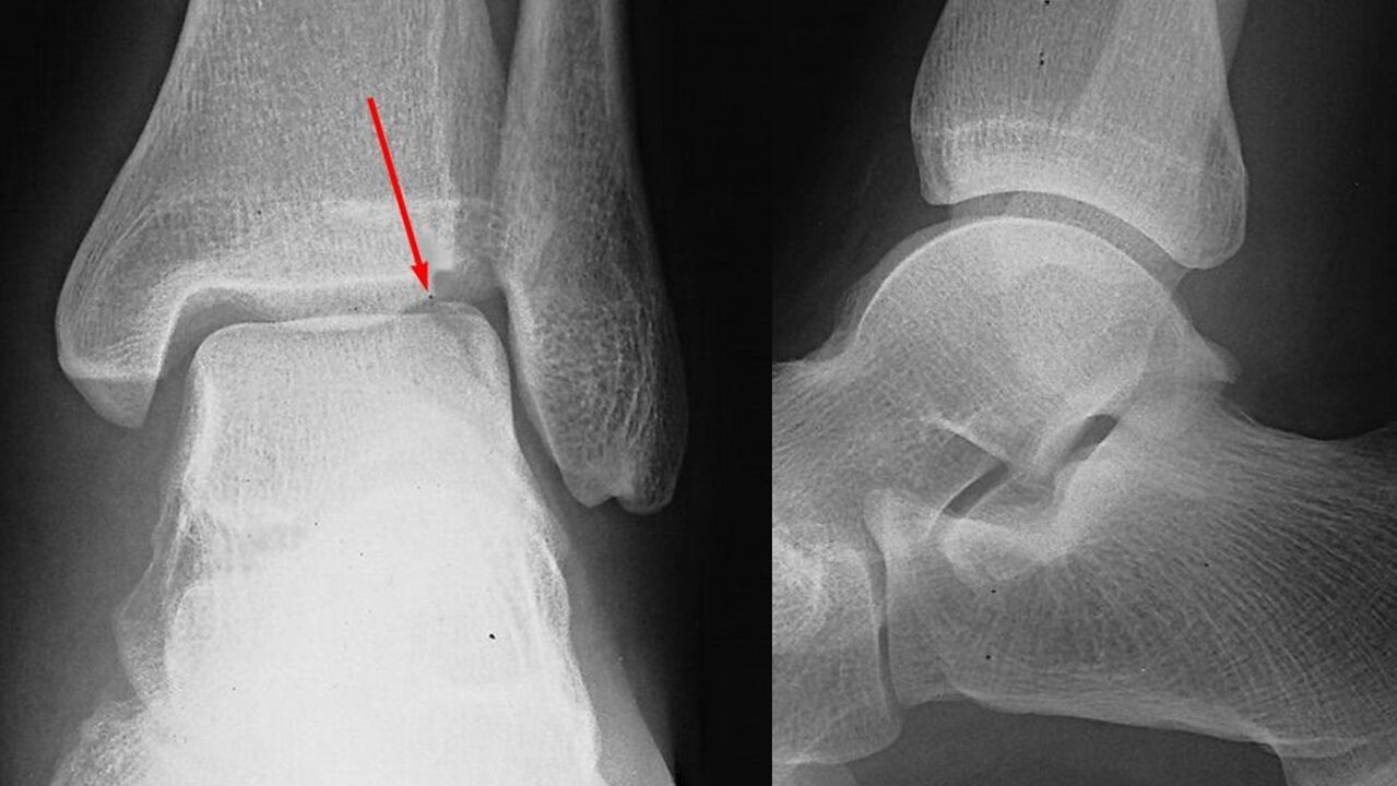 radiografia do tornozelo