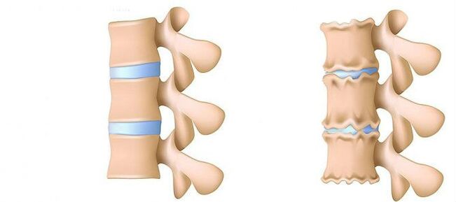 Osteocondrose de dentro