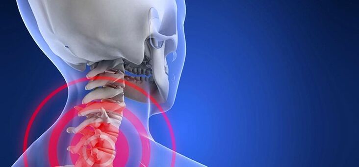 Osteocondrose da região cervical