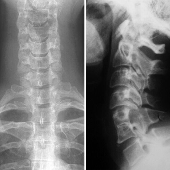 X -raio da coluna cervical