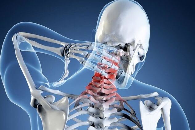 Osteocondrose da região cervical