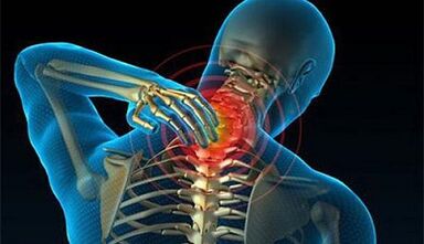 Sintomas de osteocondrose da coluna cervical