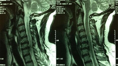 Ressonância magnética do departamento cervical