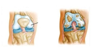 alterações patológicas na artrose do joelho