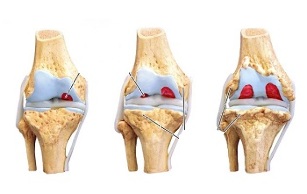 estágios de artrose da articulação do joelho