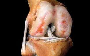 o que é artrose da articulação do joelho