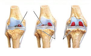 estágios de artrose do joelho