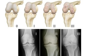 métodos para diagnosticar artrose do joelho