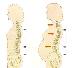 osteocondrose durante a gravidez