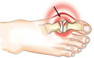 Inflamação da articulação entre o polegar e o pé na artrite