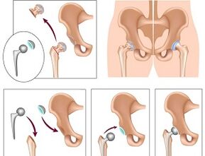 endoprótese para artrose da articulação do quadril