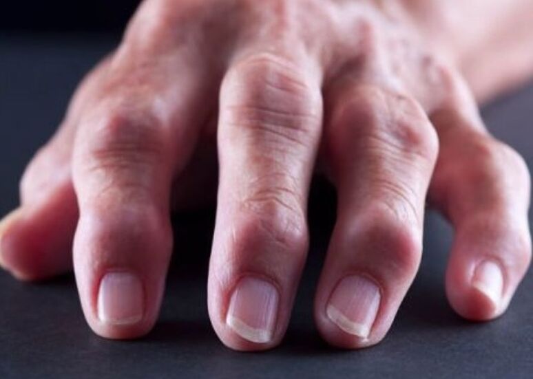 artrite reumatóide como causa de dor nas articulações dos dedos