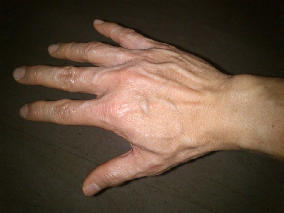 deformação dos ossos e dor nas articulações dos dedos