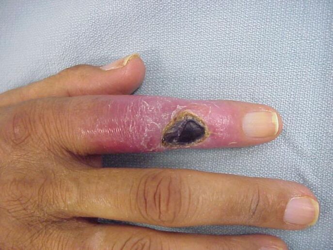 osteomielite como causa de dor nas articulações dos dedos