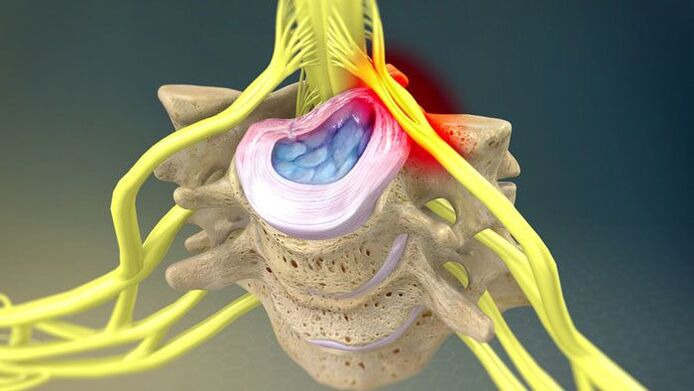 A protrusão do disco intervertebral é a causa da dor no pescoço