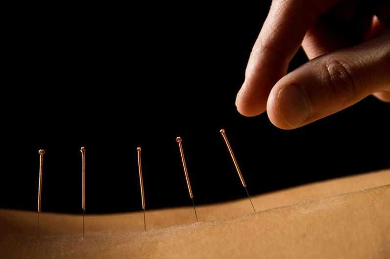 acupuntura para dores nas costas