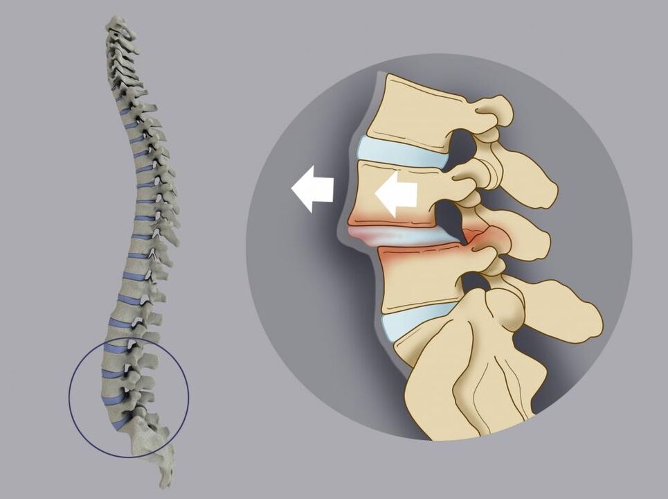 deslocamento das vértebras como causa de dores nas costas