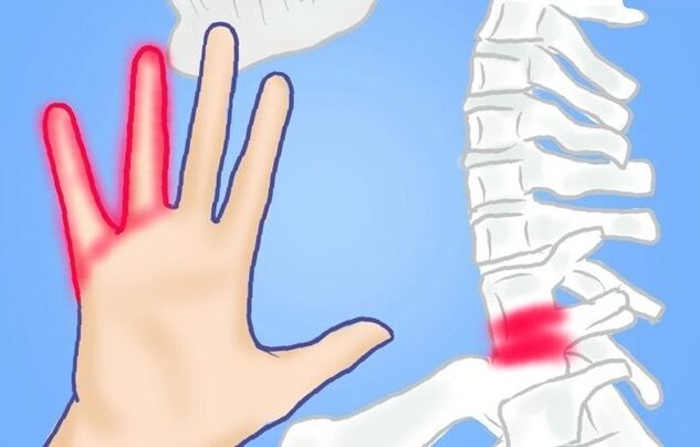 nervos comprimidos como causa de dores nas costas