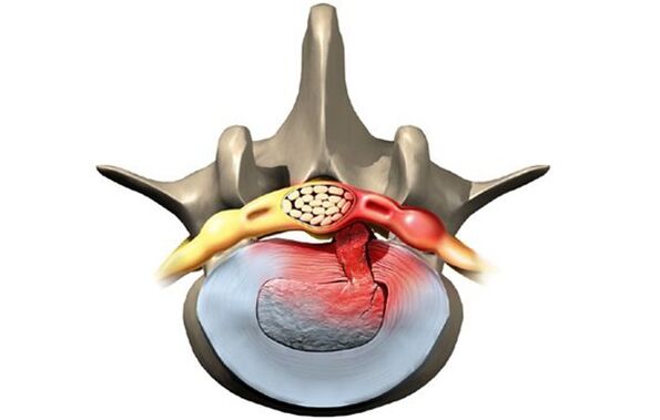 vértebra afetada por osteocondrose