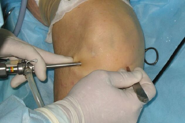 artroscopia para dor no joelho